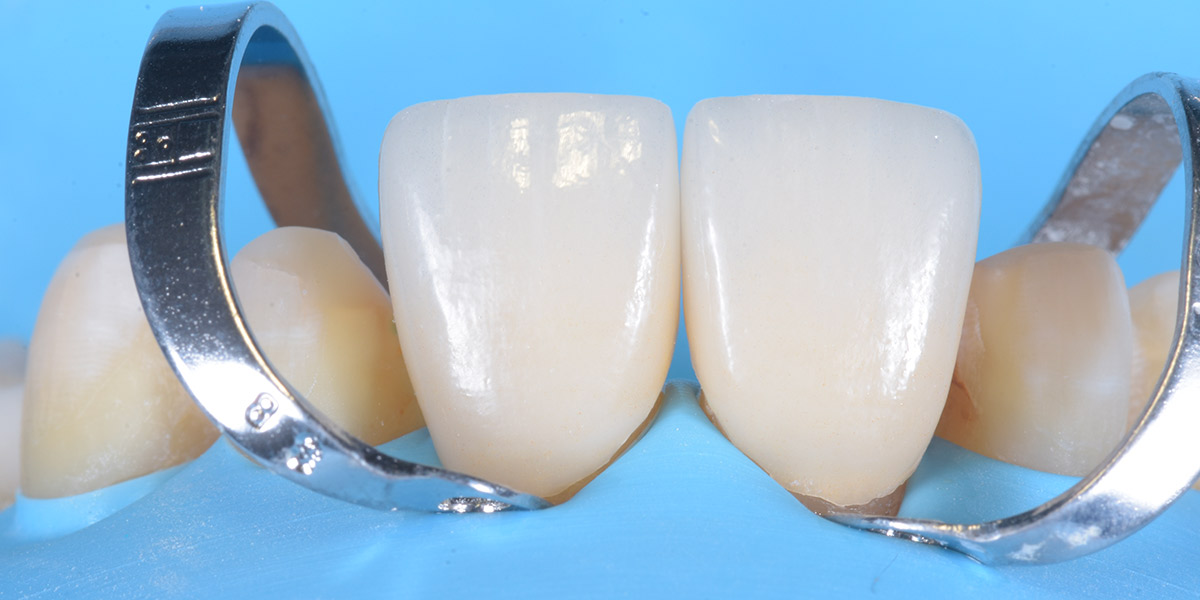 Faccette dentali cementazione 1 pieroni - Studio dentistico Pieroni