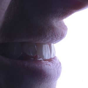 Faccette dentali risultato 2 pieroni - Studio dentistico Pieroni