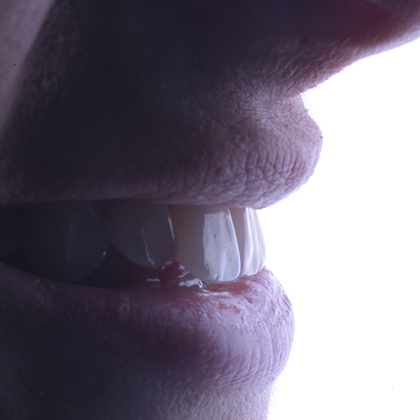 Faccette dentali risultato 2 pieroni - Studio dentistico Pieroni