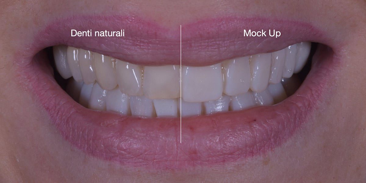 Faccette dentali studio caso mockup 4 pieroni - Studio dentistico Pieroni