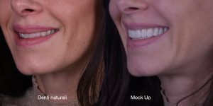 Faccette dentali studio caso mockup 5 pieroni - Studio dentistico Pieroni