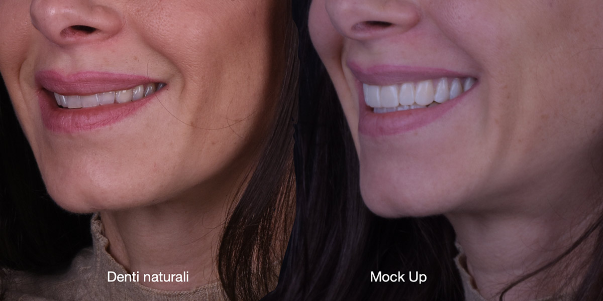 Faccette dentali studio caso mockup 5 pieroni - Studio dentistico Pieroni