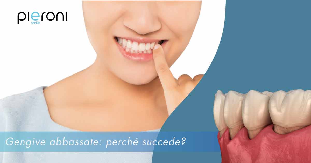 gengive abbassate||