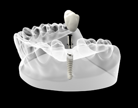 Implantologia carico immediato pieroni - Studio dentistico Pieroni