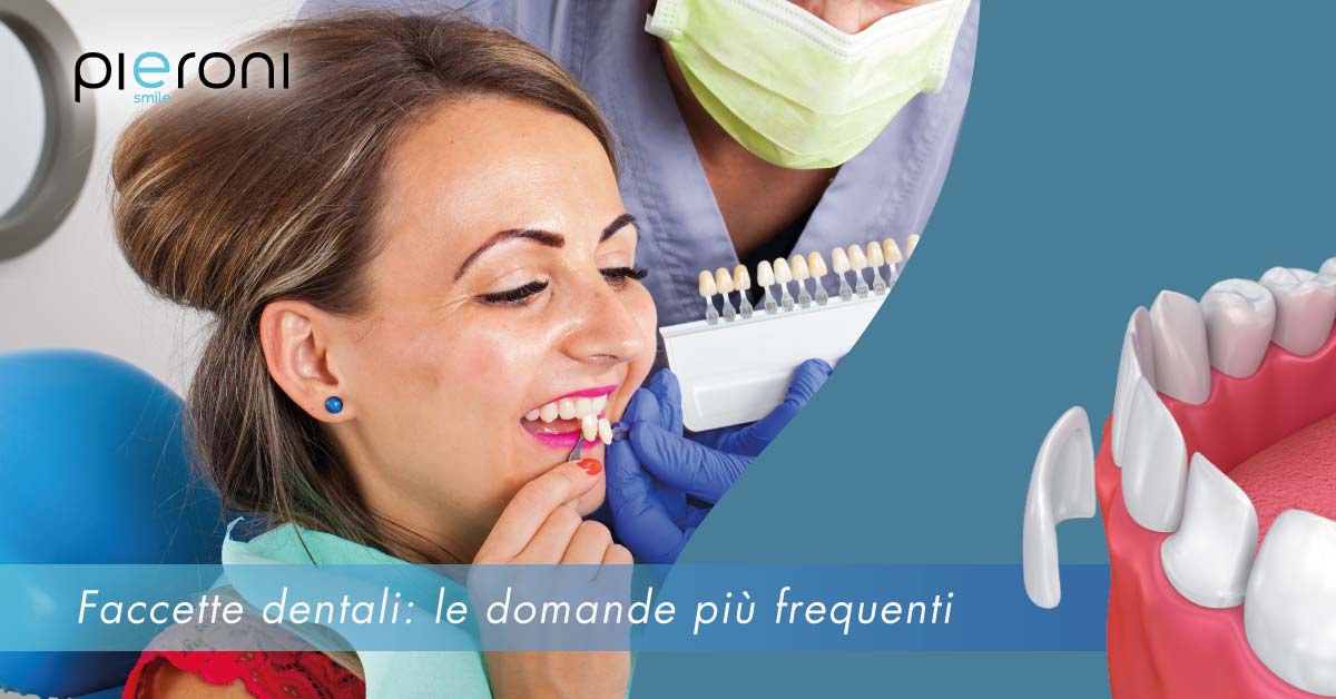 news_faccettedentali