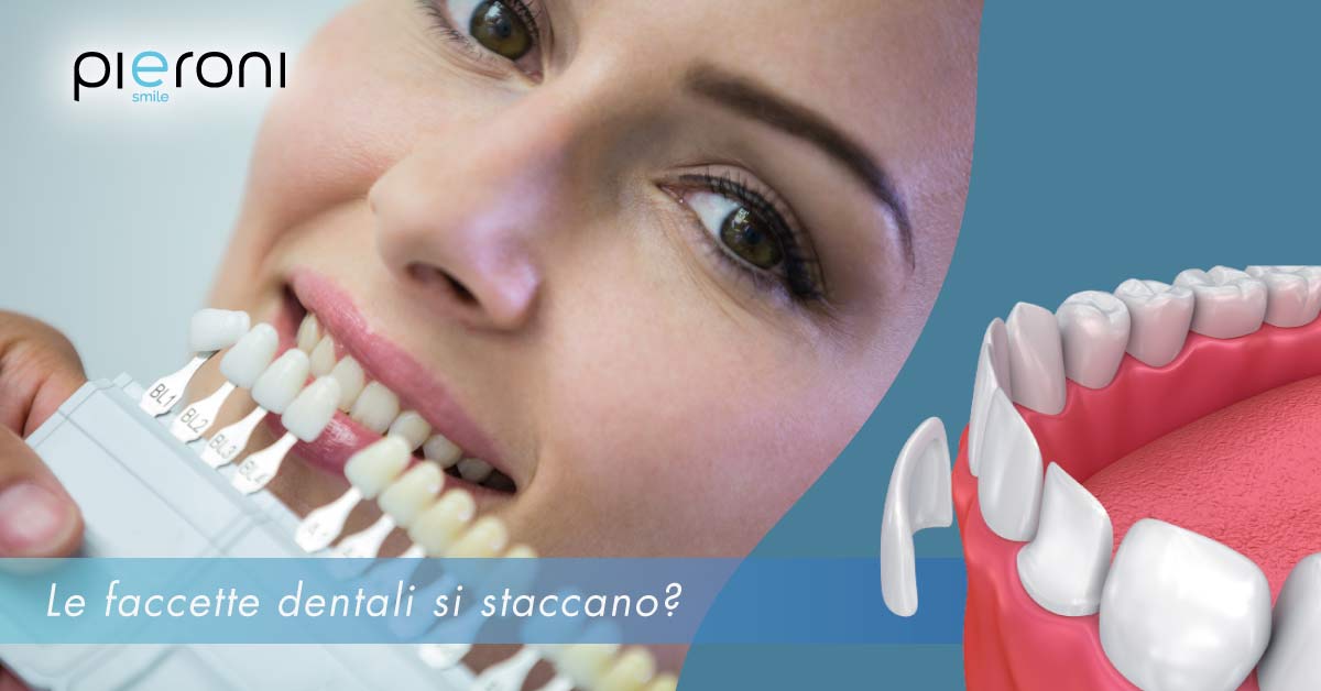 faccette-dentali-che-si-staccano