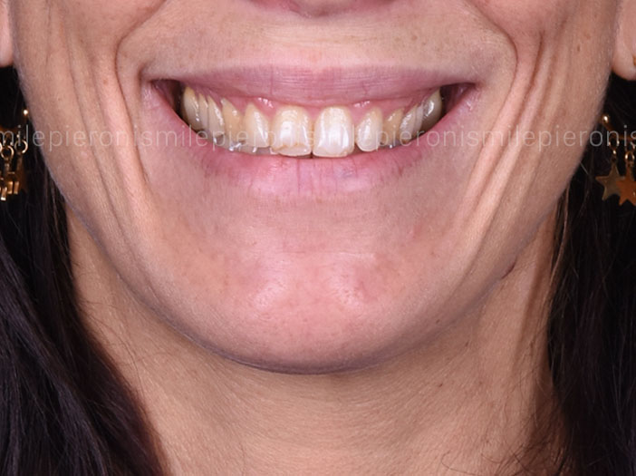 Pieroni Caso1 - Studio dentistico Pieroni