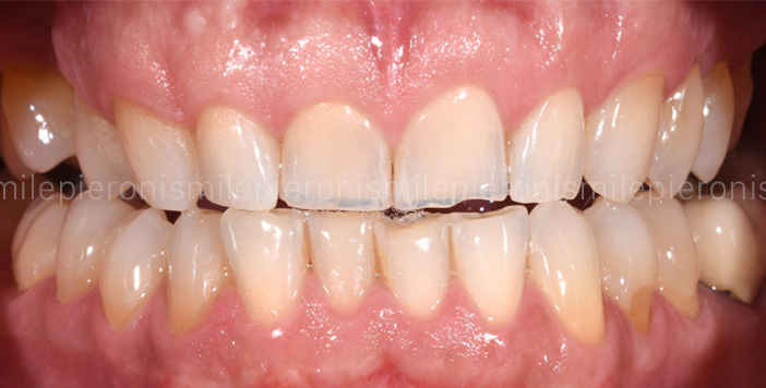 Pieroni Caso10 - Studio dentistico Pieroni