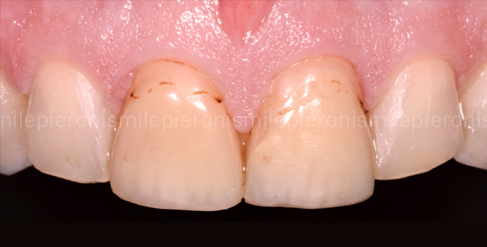 Pieroni Caso11 - Studio dentistico Pieroni