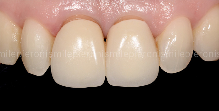 Pieroni Caso12 - Studio dentistico Pieroni