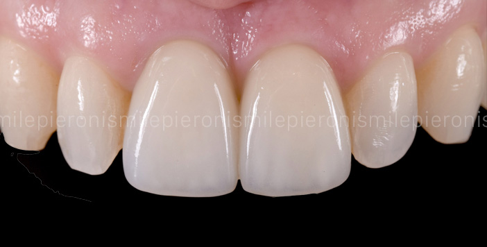 Pieroni Caso12 dopo - Studio dentistico Pieroni