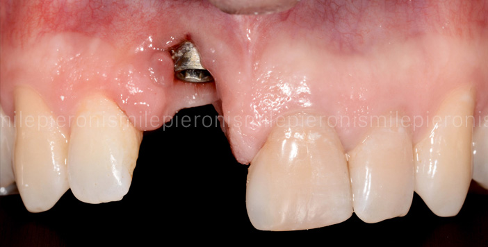 Pieroni Caso13 - Studio dentistico Pieroni