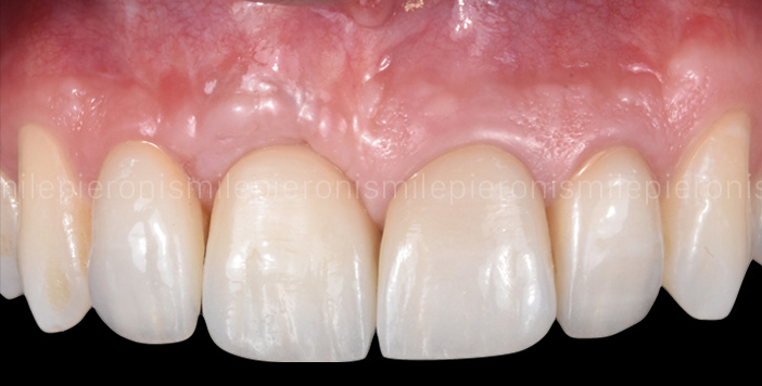 Pieroni Caso13 dopo - Studio dentistico Pieroni