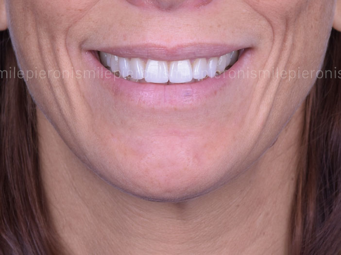 Pieroni Caso1 dopo - Studio dentistico Pieroni