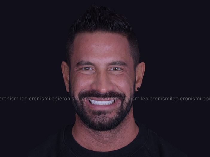 Pieroni Caso2 dopo - Studio dentistico Pieroni