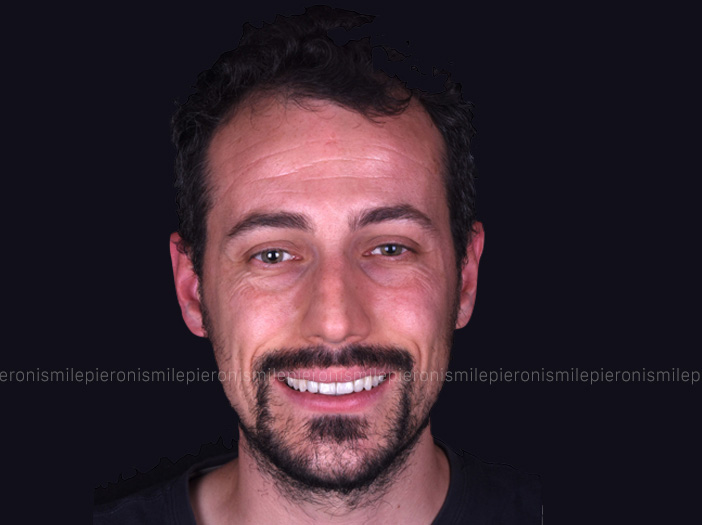 Pieroni Caso5 dopo - Studio dentistico Pieroni