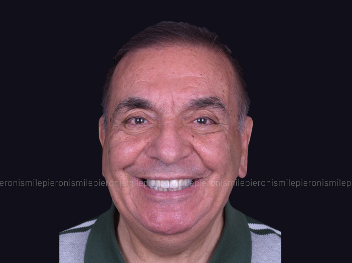 Pieroni Caso6 dopo - Studio dentistico Pieroni