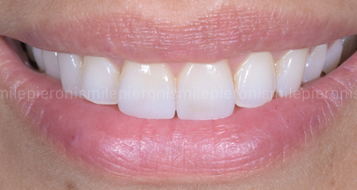 Pieroni Caso7 dopo - Studio dentistico Pieroni