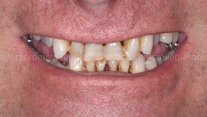 Pieroni Caso8 - Studio dentistico Pieroni