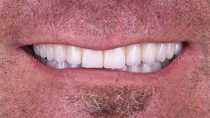 Pieroni Caso8 dopo - Studio dentistico Pieroni