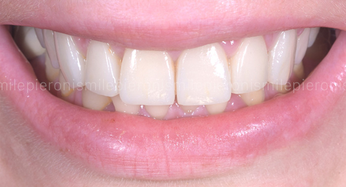 Pieroni Caso9 dopo - Studio dentistico Pieroni