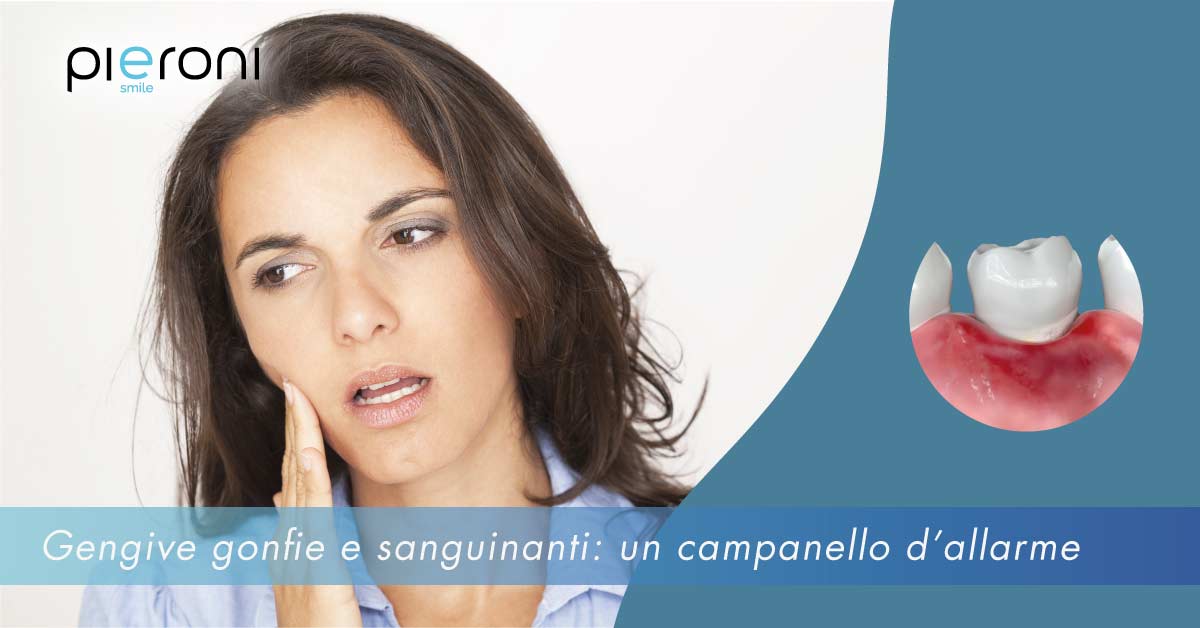gengive gonfie e sanguinanti||