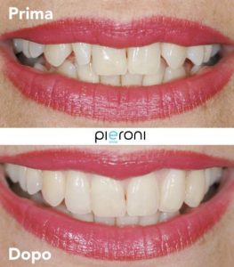 come avere un sorriso smagliante2 e1569835881635 - Studio dentistico Pieroni