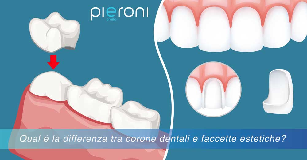 differeza-corone-dentali-faccette-estetiche|differenza-corone-dentali-faccette-estetiche|differenza-corone-dentali-faccette-estetiche