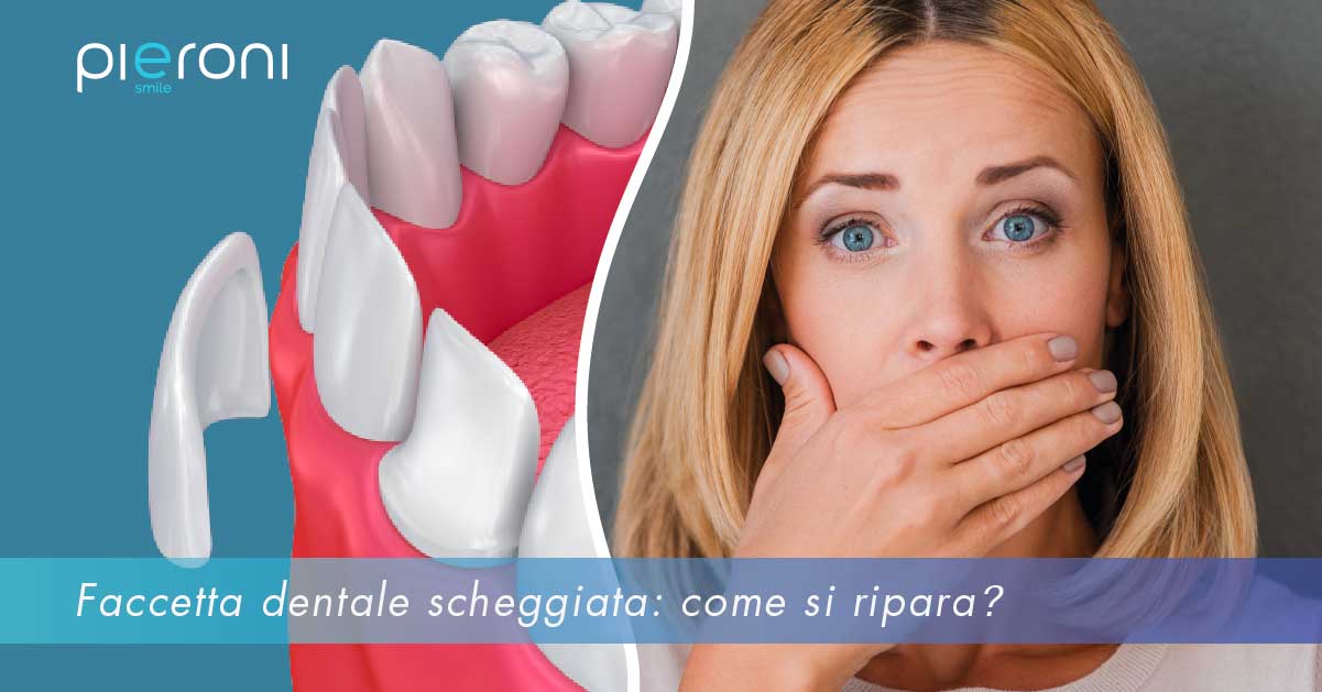 faccetta-dentale-scheggiata-come-si-ripara