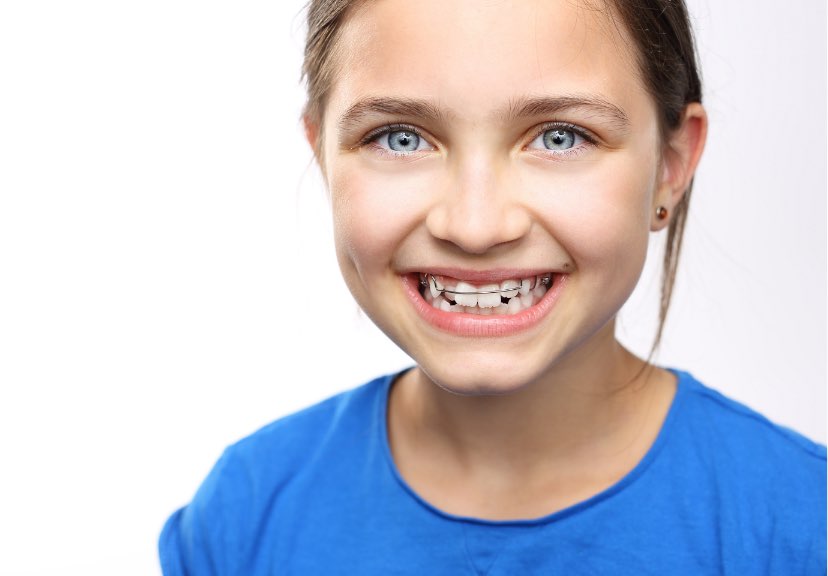 apparecchio bambini a Milano Porta Venezia | Studio Dentistico Pieroni|Apparecchio bambini