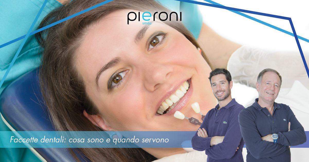 faccette dentali