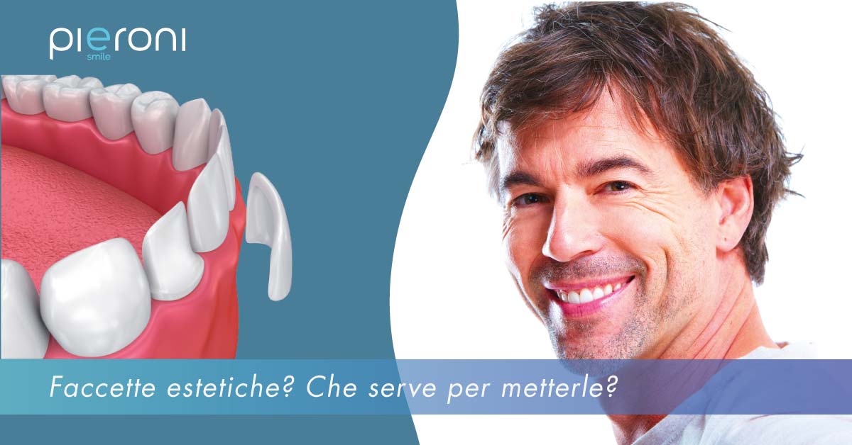 news-faccette_estetiche|faccette dentali