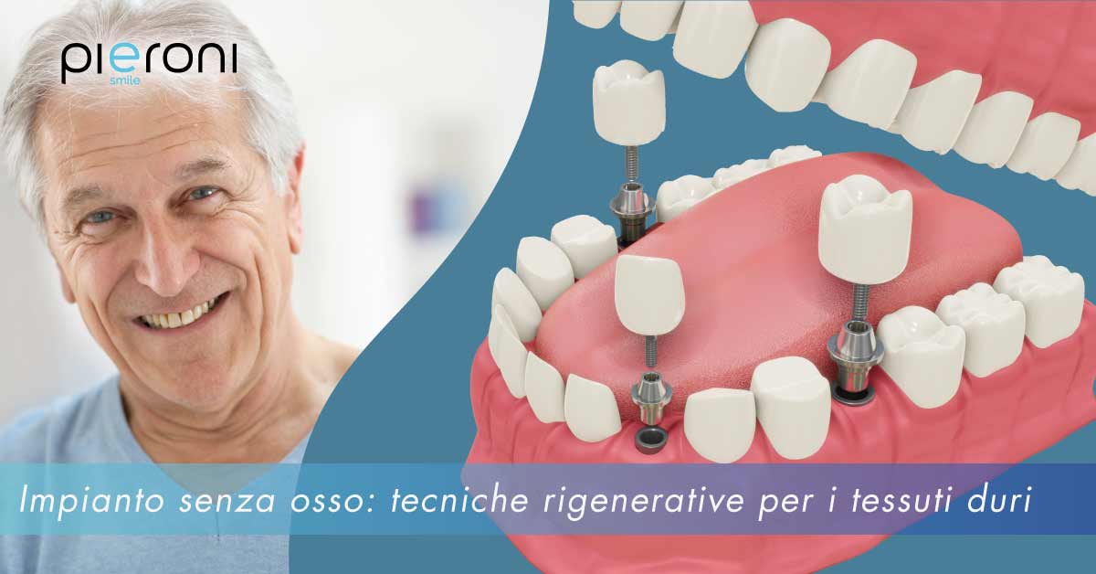 impianto-dentale-senza-osso|||