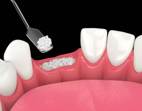 rigenerativa ossea pieroni - Studio dentistico Pieroni